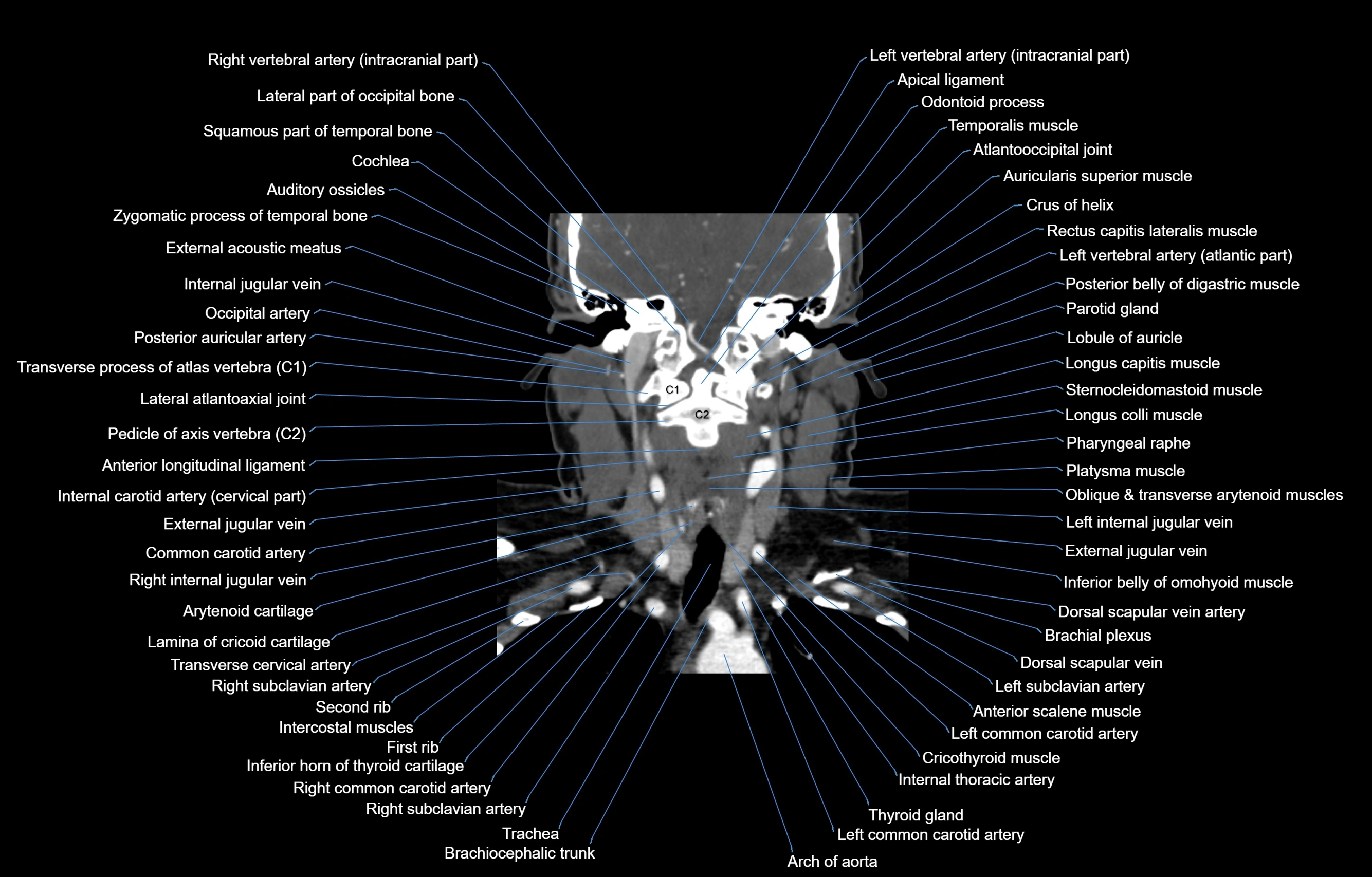 CT Neck coronal  cross sectional anatomy labelled 3D  radiology  image-00038.webp